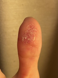 突然手の親指の皮が剥けてとても痛いです他の指は何もなく 親指だ Yahoo 知恵袋