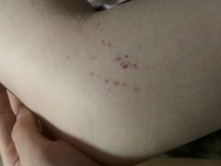 皮膚にできる赤い斑点について質問です たまに二の腕や 太もも ヒザの内側 Yahoo 知恵袋