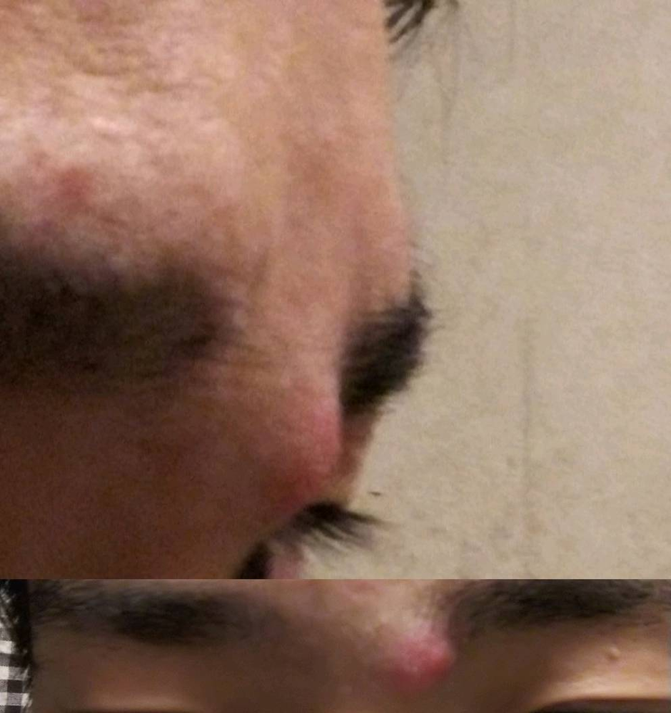 ニキビケア すべての質問 Yahoo 知恵袋