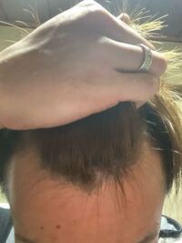 M字ハゲで悩んです 今年24歳です おすすめの薬など使っ Yahoo 知恵袋