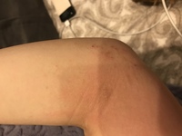 ひじの内側が赤くかぶれのようになってとても痒いのですがこれは湿 Yahoo 知恵袋