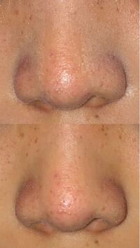 鼻の毛穴詰まりを治したいです 上は化粧をしてマスクし Yahoo 知恵袋