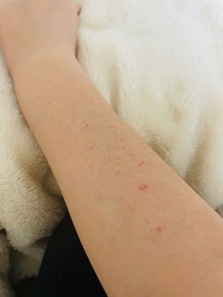 ストレスとかで情緒不安定になると 爪で腕や手の甲 顔を引っかい Yahoo 知恵袋
