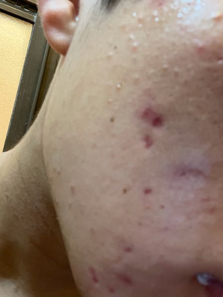 ニキビ跡が凄いです 写真の他にも顎などにもニキビ跡があります ビタ Yahoo 知恵袋