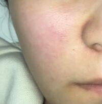 すっぴんなのですが肌の赤み小鼻周りを綺麗にするにはどうしたらい Yahoo 知恵袋