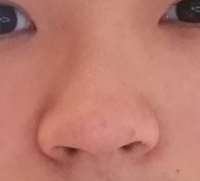 これは豚鼻ですよね 治したいのですが整形はしたくありません 金銭的な面と整 Yahoo 知恵袋