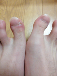 左足の親指の怪我が2週間以上治りません 何かの病気でしょうか Yahoo 知恵袋