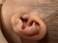 生後一ヶ月の赤ちゃんの耳の付け根に写真のようなブツブツがあります 写真に Yahoo 知恵袋