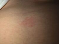 汚い写真ですみません 体に3箇所この写真のように赤くなってると Yahoo 知恵袋