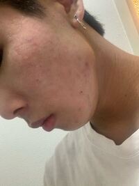 こんな感じのニキビ跡と関係ないカサカサした赤みが顔中に広がっているのです Yahoo 知恵袋