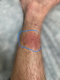 高校生です アトピー用のステロイドを毎日塗っている部分 脛 が Yahoo 知恵袋