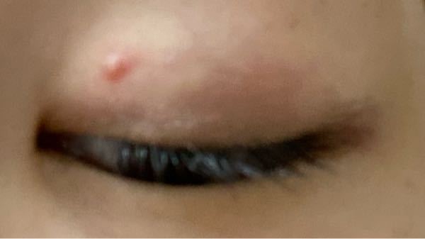 二重埋没をしてから2ヶ月経つのですが 埋没後に白いニキビみたいなのができ Yahoo 知恵袋