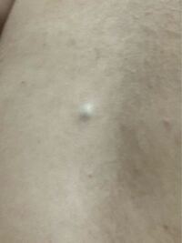 背中にプクッと硬い出来物ができたのですが これって粉瘤でしょう Yahoo 知恵袋