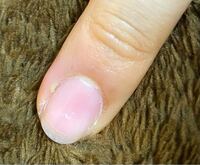 この爪の横の黄色い部分 写真だと左 は化膿ですか 確か数 Yahoo 知恵袋