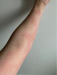 湿疹 夜になると体が痒い 皮膚掻痒症（ひふそうようしょう）について