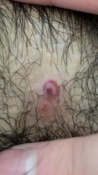 閲覧注意 男です 汚い画像で申し訳ないです 陰部 膀胱の部分 にニキビ Yahoo 知恵袋