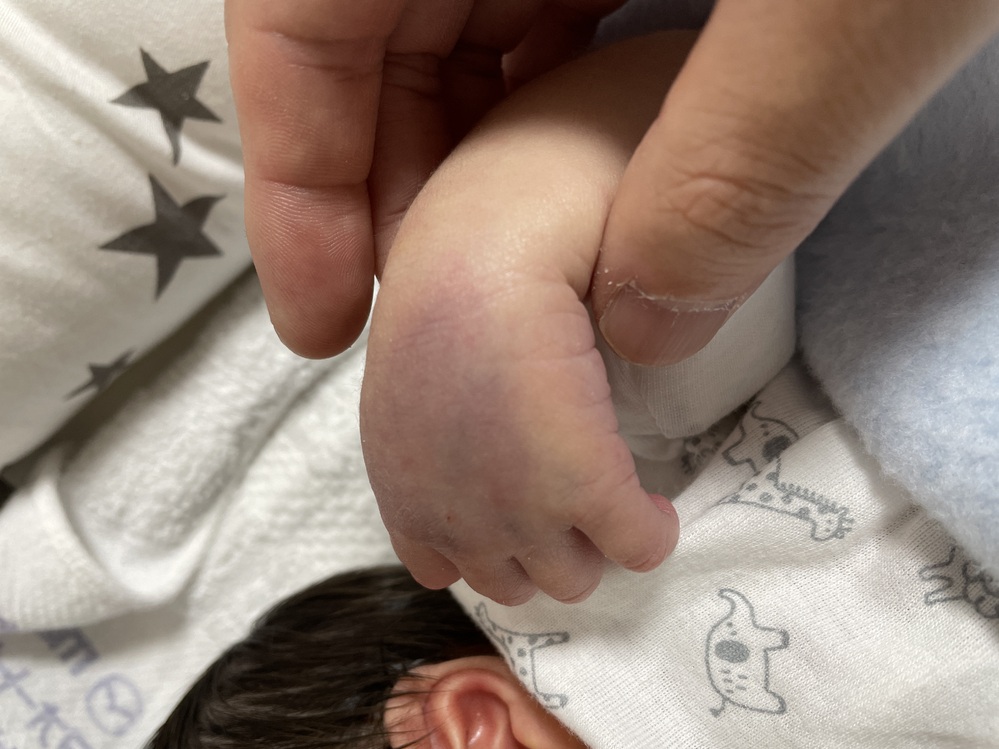 生後６日の子の左手の甲が紫色に変色し腫れています チャイルドシート Yahoo 知恵袋