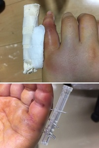 2日前 手の小指を螺旋骨折しピンニング手術を大きな病院で受けま Yahoo 知恵袋