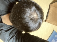 もともと髪の本数が少ないのもあると思うのですが はげてきてます Yahoo 知恵袋