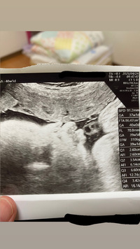 現在40週の赤ちゃんのエコー写真です 横顔なのですが唇が3つぐらいに割れ Yahoo 知恵袋