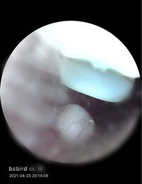 閲覧注意です耳の病気 耳掃除をしていたら 白い塊のような Yahoo 知恵袋