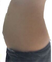 食後のお腹の張りが酷くて悩んでいます 過敏性腸症候群かと Yahoo 知恵袋