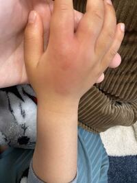 4歳の子どもですが 指を蜂に刺されて1週間後に腫れてきました ﾟdﾟ Yahoo 知恵袋
