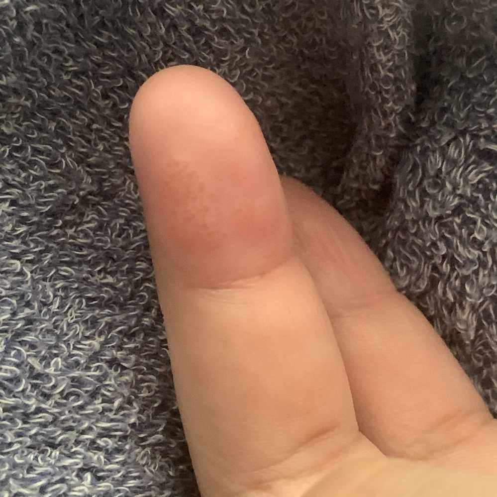 皮膚の病気 アトピー 解決済みの質問 Yahoo 知恵袋