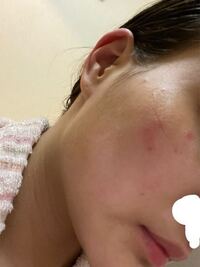 最近肌が荒れて 頬の辺りに赤い湿疹 が出来て保湿するとヒリヒリ Yahoo 知恵袋