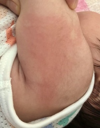 最近 生後2ヶ月半の赤ちゃんの肌が頻繁に画像のように赤くなりま Yahoo 知恵袋