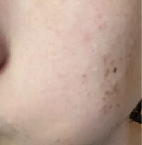 このニキビ跡を治すにはどんな市販薬が効きますか 一番濃い Yahoo 知恵袋