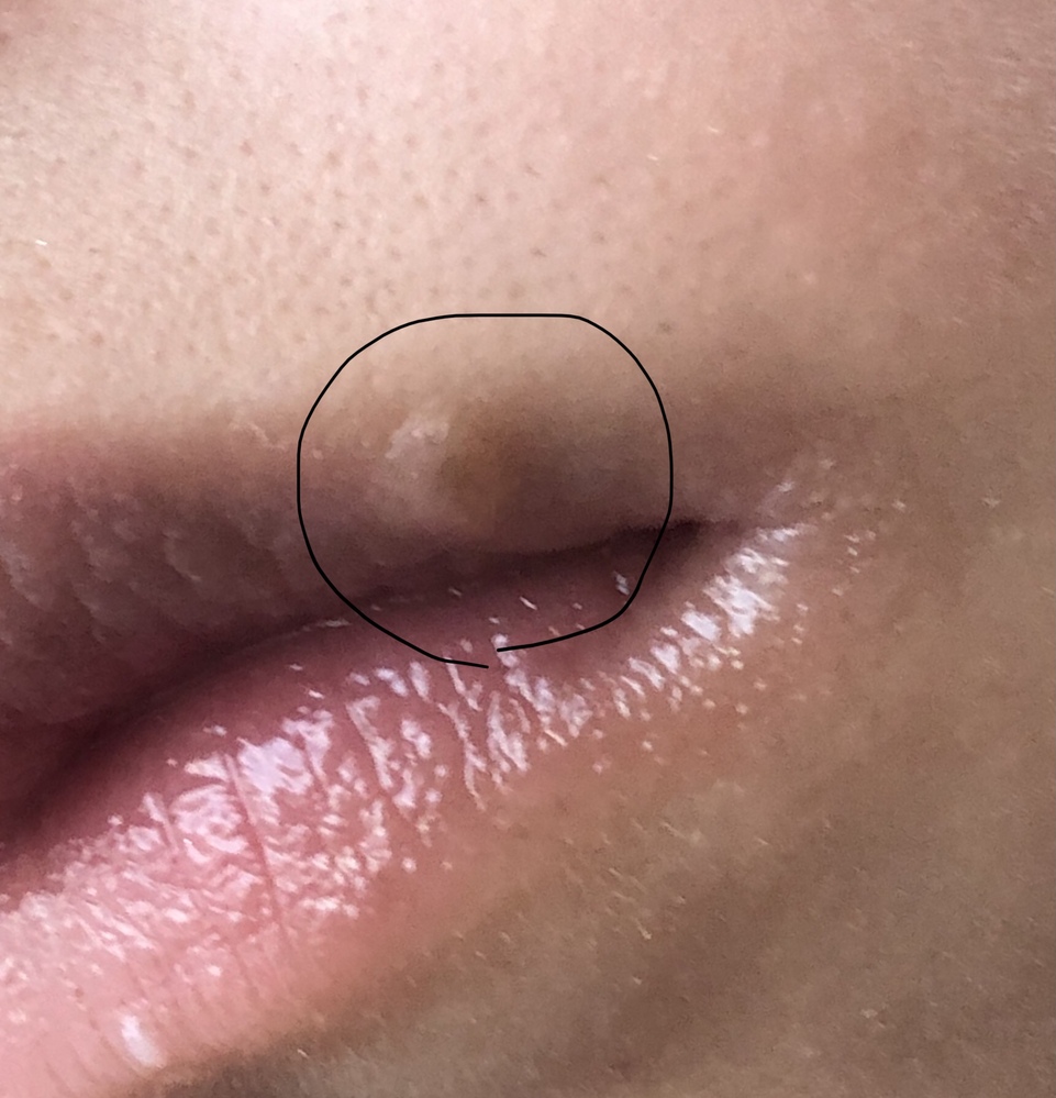 唇にできたできものが治りません 痛みはなくヘルペスと Yahoo 知恵袋