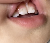1歳半の子供の歯です 毎日朝昼晩と歯磨きを頑張っていたのですが 黒く見え Yahoo 知恵袋