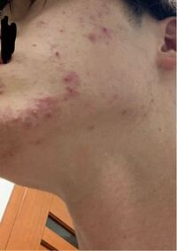 これニキビですか とびひですか 今までニキビできてもすぐ治ったのにこれは Yahoo 知恵袋