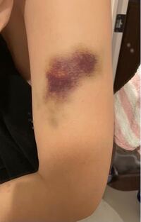 彼氏に殴られました アザの写真がありますので苦手な方は気 Yahoo 知恵袋