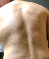 この背中ニキビはひどいですか Yahoo 知恵袋