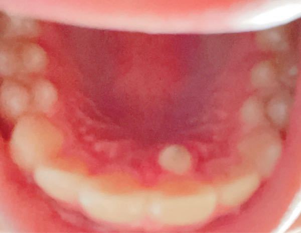 高校生の男子です。 - 歯医者に行って次上顎の過剰歯を抜歯する 