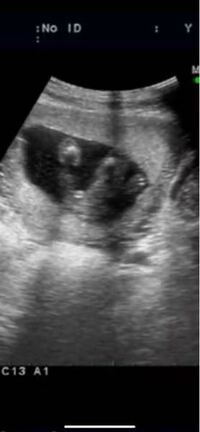 妊娠16週の妊婦です 本日検診に行って エコーを見たら先生が あー Yahoo 知恵袋