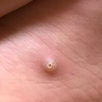 子供の風呂上がりに撮影した足の裏のイボのようなものです これはなんですか Yahoo 知恵袋