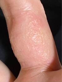 閲覧注意 エボラ出血熱の怖さがわかる画像まとめ ぴよ速 E
