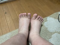 浮腫について今日片足だけ浮腫が出ました明らかにこれ浮腫んでると Yahoo 知恵袋