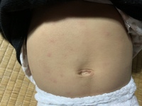 １歳の子供ですが顔 特に目の横 目尻部分 やお腹 背中 太もも Yahoo 知恵袋