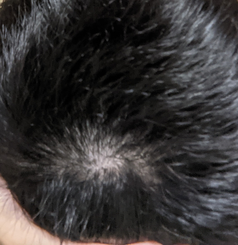 高校生です つむじ周りなんですけど薄いですよね まだ17に Yahoo 知恵袋