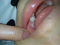 2歳7ヶ月の娘の歯について 今日歯磨きをしている時に 下の1番奥の歯 Yahoo 知恵袋