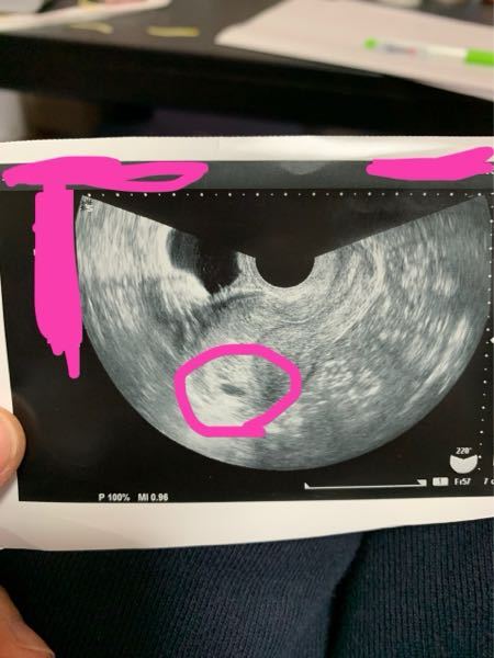 エコー写真について 5週ピッタリくらいに病院に行き 赤ちゃんはまだ見 Yahoo 知恵袋