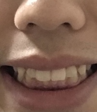 出っ歯ですか 出っ歯だったら直した方がいいほどやばい出っ歯です Yahoo 知恵袋