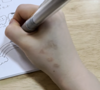 これって根性焼きの跡ですか 彼女の手になぞの火傷痕みたい Yahoo 知恵袋