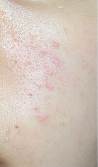 塗り薬 塗り 方 ニキビ