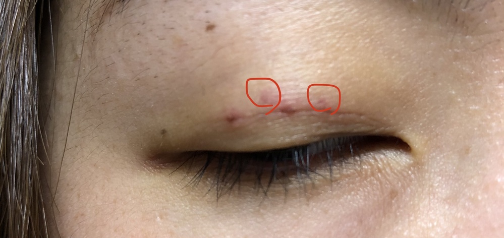 1ヶ月前に埋没法で二重にしました ですが 糸が出てきてしまい 同じ位置に Yahoo 知恵袋