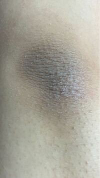 腕 肘の内側 の黒ずみが消えません 去年はこんな酷くなかった Yahoo 知恵袋